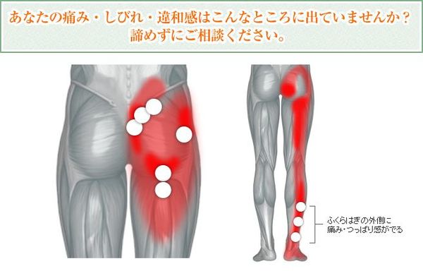 坐骨神経痛の説明