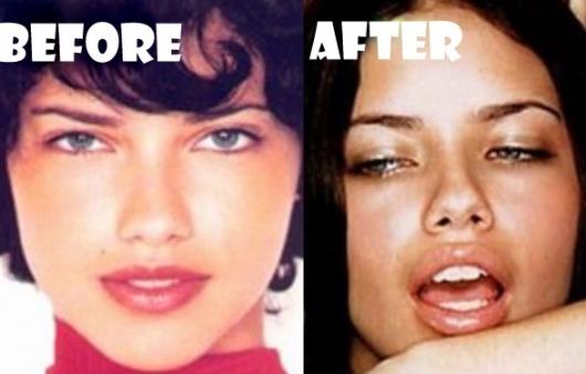 セレブになりたい セレブの整形