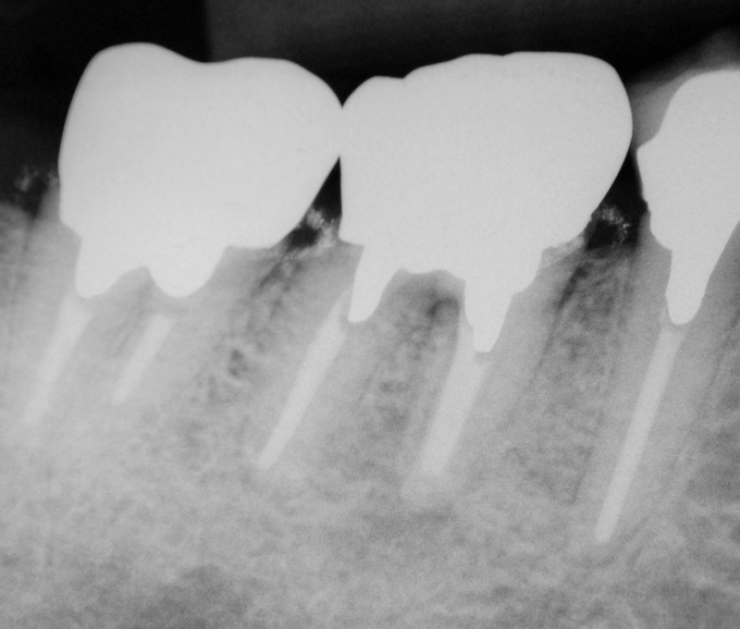 ブログ.歯根端切除術のウソホント