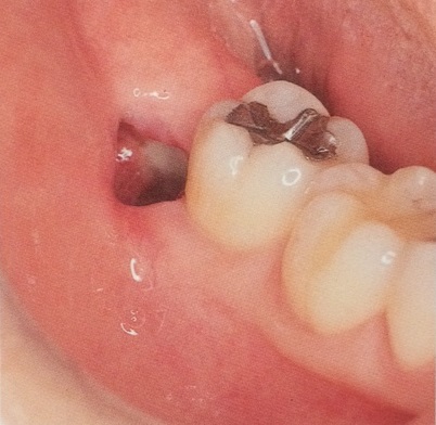 歯根端切除術の相談コーナー ドライソケットの治療
