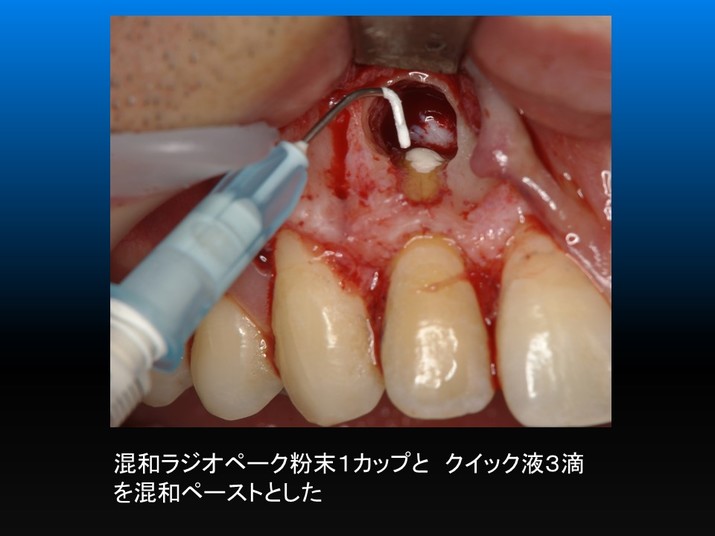 歯根端切除術の術式