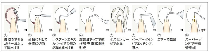 歯根端切除術の相談コーナー